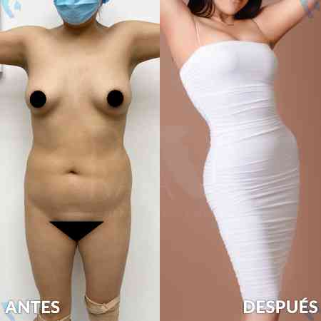 Liposculpture HD-33
