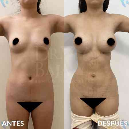 Lipoescultura HD-34