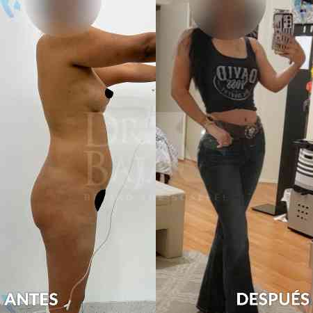 Liposculpture HD-35