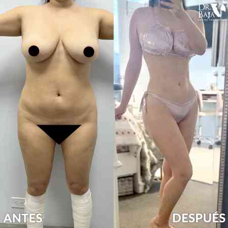 Lipoescultura HD-42