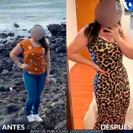 Liposculpture HD-46