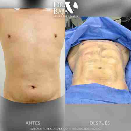 Liposculpture HD-48