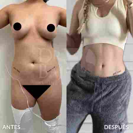 Liposculpture HD-45