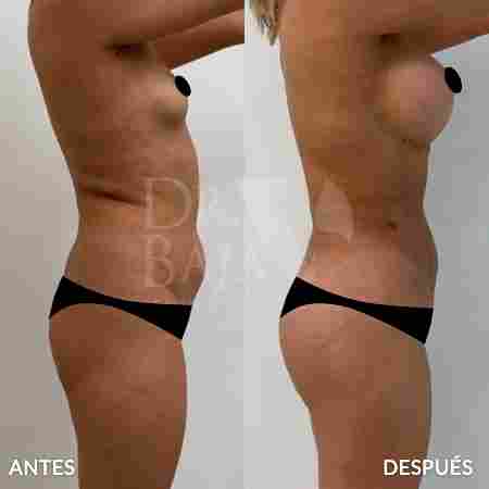 Liposculpture HD-48