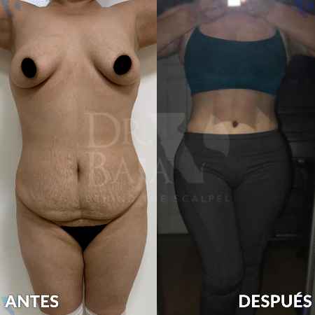 Lipoescultura HD con Lipomarcación-2