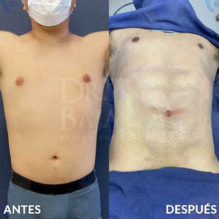 HD Liposculpture with Lipomarking-3