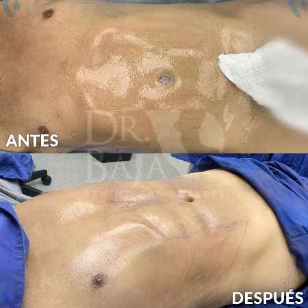 Lipoescultura HD con Lipomarcación-4