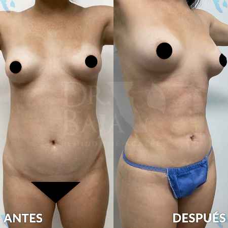 Lipoescultura HD con Lipomarcación-6