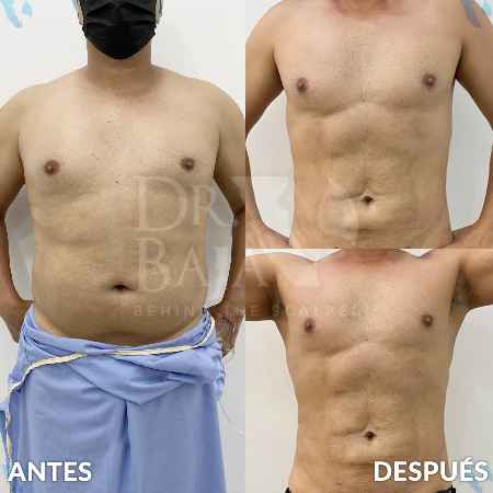 Lipoescultura HD con Lipomarcación-10