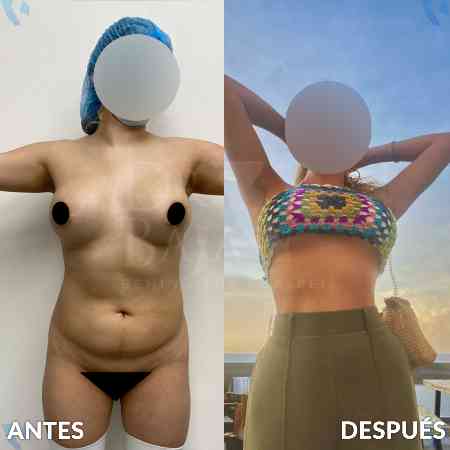 Lipoescultura HD con Lipomarcación-12
