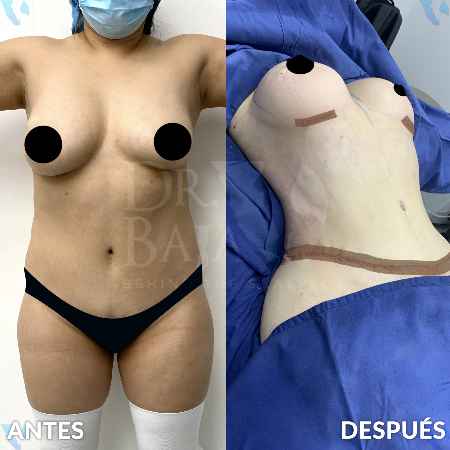 Mastopexy-3