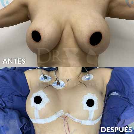 Mastopexy-7