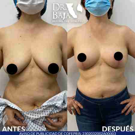 Mastopexy-11