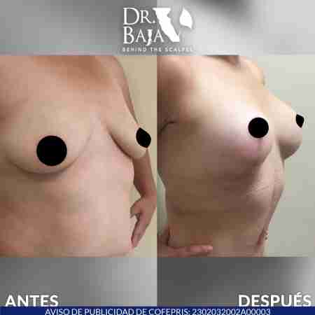 Mastopexy-16