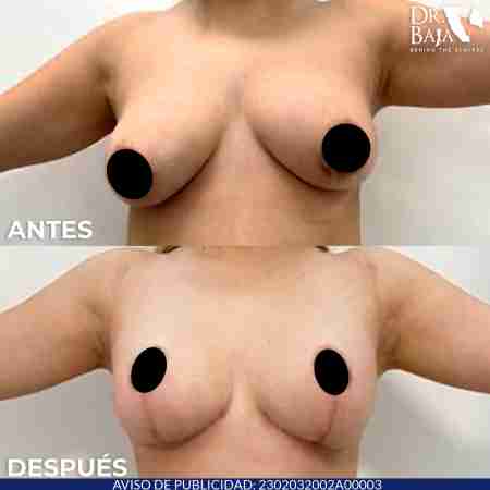 Mastopexy-17