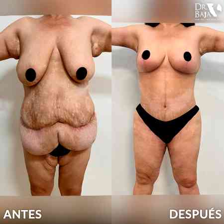 Mastopexy-22