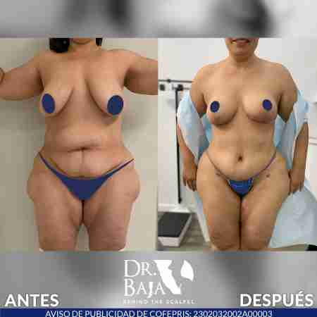 Mastopexy-25