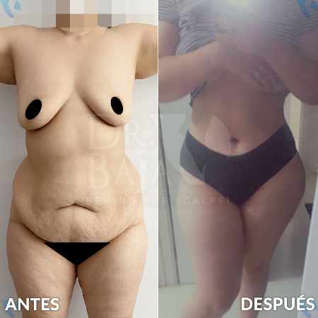 Mommy Makeover-19