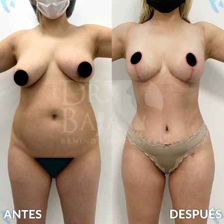Mommy Makeover-30