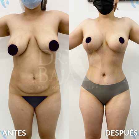Mommy Makeover-38