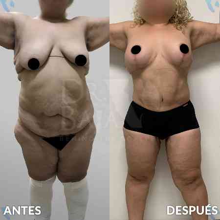 Mommy Makeover-45