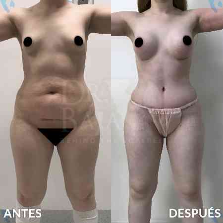 Mommy Makeover-48