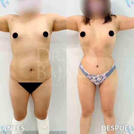 Mommy Makeover-56