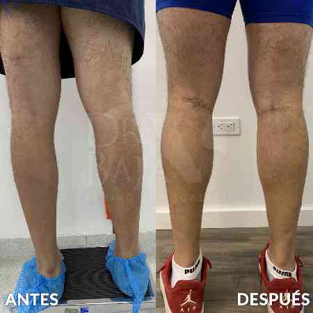 Pantorrilla-1