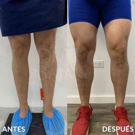 Pantorrilla-2