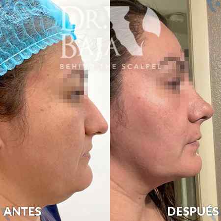 Liposucción de papada y cuello-3