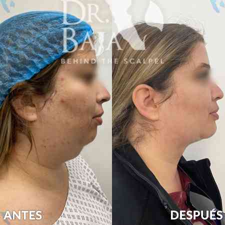 Liposucción de papada y cuello-4