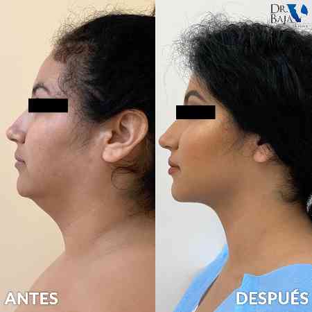 Liposucción de papada y cuello-6