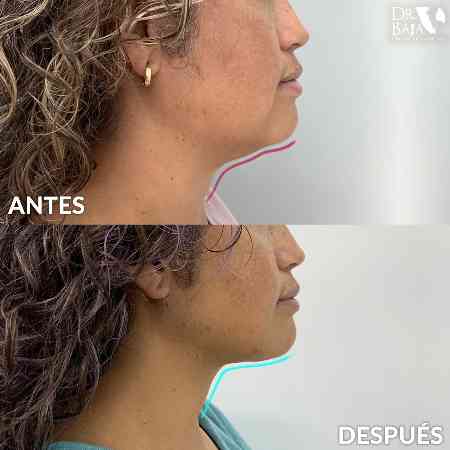 Liposucción de papada y cuello-9