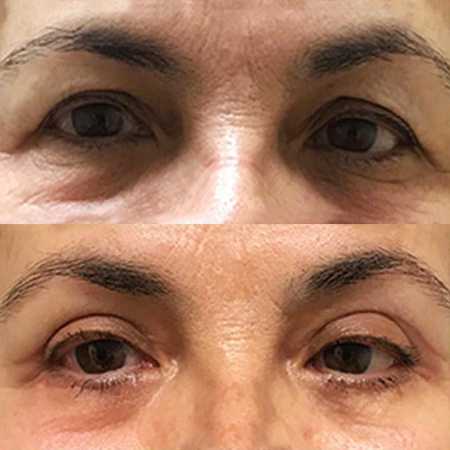 Blefaroplastia-3