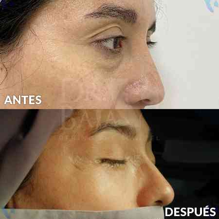 Blefaroplastia-4