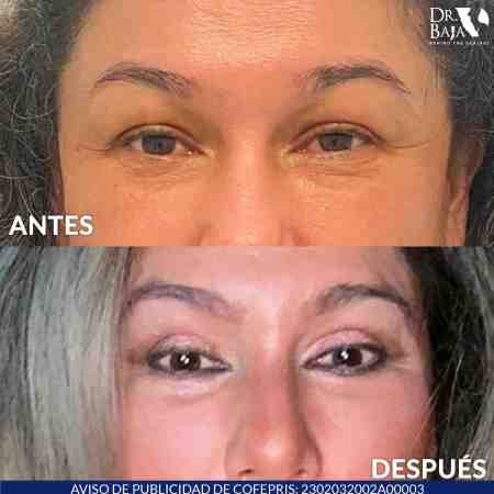 Blepharoplasty-6