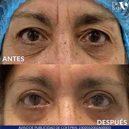 Blepharoplasty-7