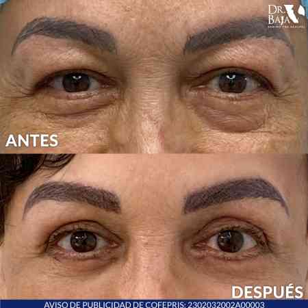 Blepharoplasty-8