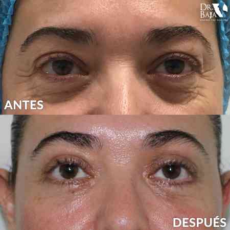 Blefaroplastia-9