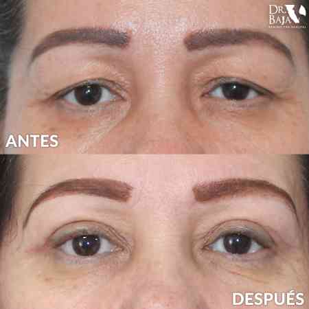 Blefaroplastia-10