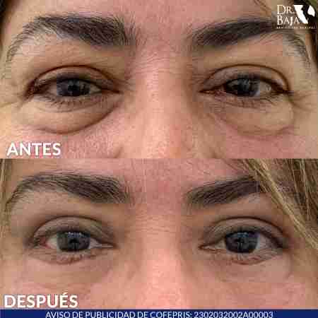 Blefaroplastia-11