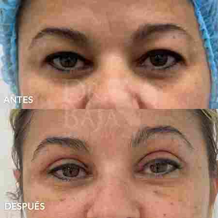 Blefaroplastia-12