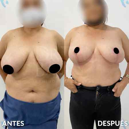 Reducción de Senos-4