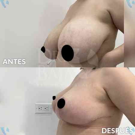 Reducción de Senos-6