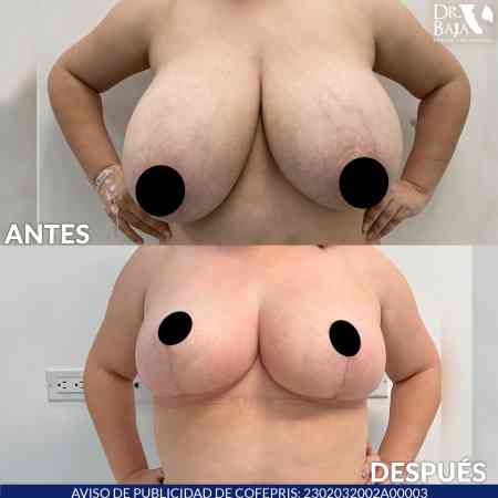 Reducción de Senos-7