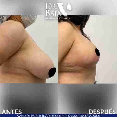 Reducción de Senos-11