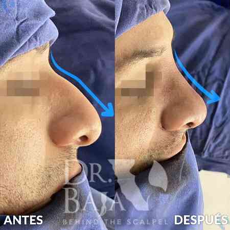 Rinoplastia-2