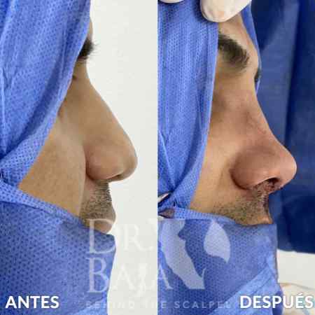 Rinoplastia-8