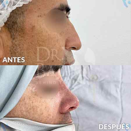 Rinoplastia-12